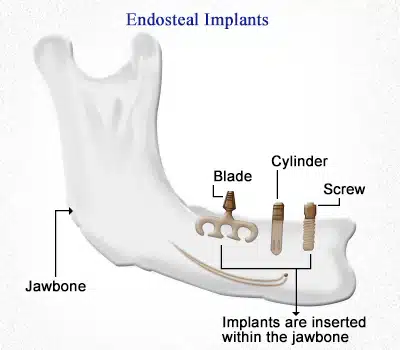 Dental implants turkey