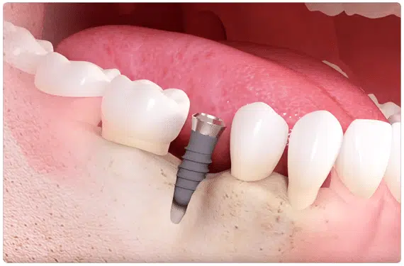 full mouth dental implants turkey package deals reviews